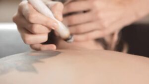 Met een moxa-stick het litteken na een keizersnede behandelen